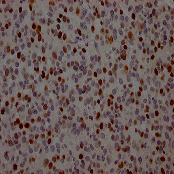 IHC Validation of TP53 Expression in Paraffin-Embedded Human Glioma Cancer Using TP53 Recombinant Monoclonal Antibody