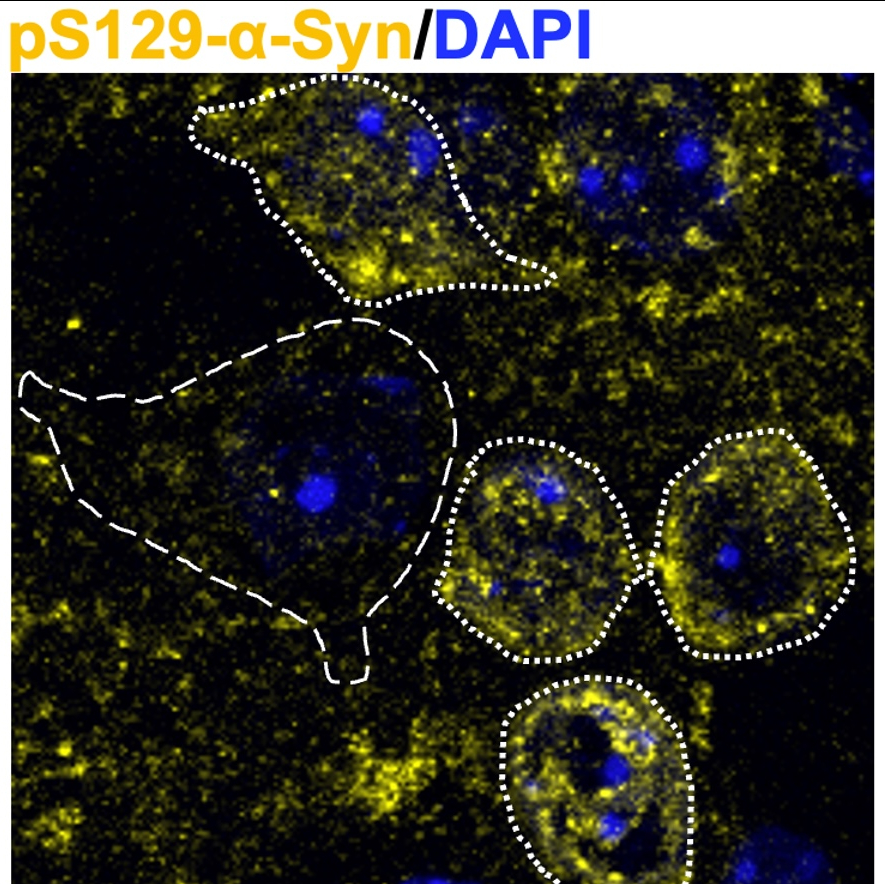 A CellProfiler Pipeline for Quantification of p-SNCA in Mouse Striatal Cholinergic and Medium Spiny Neurons