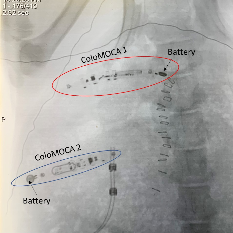 Dual coloMOCA implantation protocol 