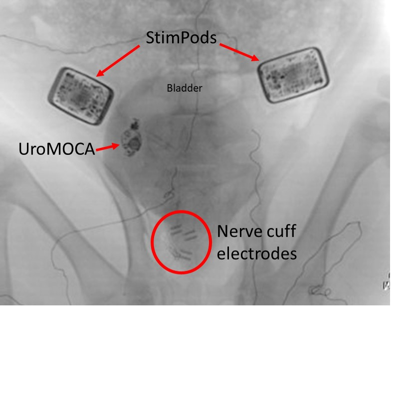 UroMOCA and StimPod Device Implantation