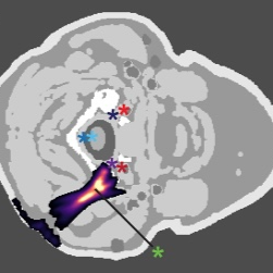 Simulation of MR-Guided Focused Ultrasound for Cervical Facet Joint Ablation Using MRI and CT-Based Anatomical Models